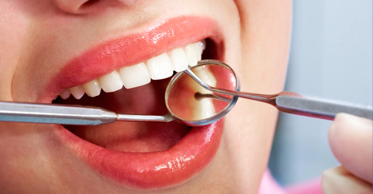 Wie lange halten Veneers