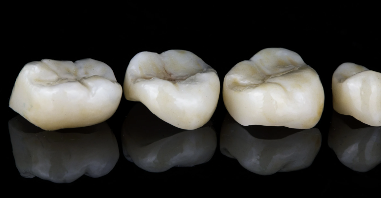 Was sind veneers